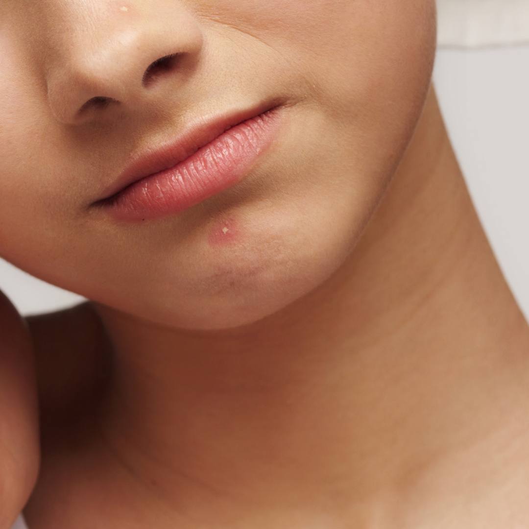 Pickel und Unreinheiten trotz fettarmer Haut?